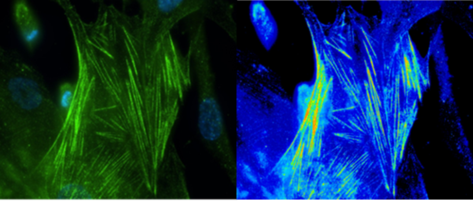 fibrosis1